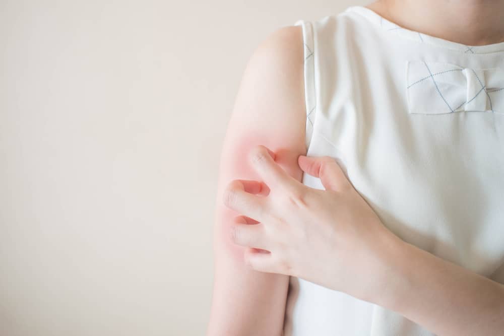 Cara Mengatasi Gatal Akibat Alergi